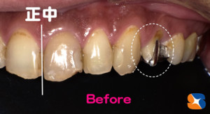 少し奥に保険でも白い歯