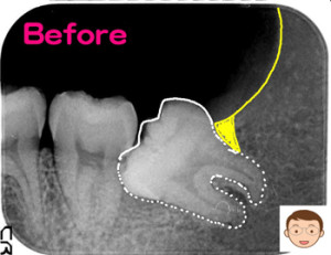 歯の根は曲がり　骨にも引っ掛る