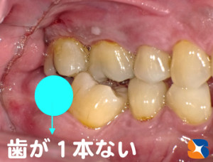下の奥歯　抜いたまま放置　噛み合わせ狂う