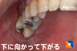 奥歯　歯を抜いたまま放置　歯並び悪くなる