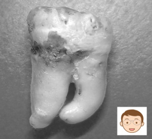 根が曲がっていると骨との癒着が強くなり難抜歯になる