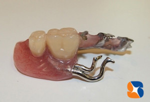 入れ歯を入れて噛み合わせを維持させる