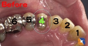 犬歯の奥は保険では銀歯