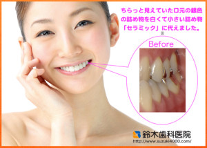 患者様のためのCerec　