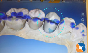 PC画面で歯の形を設計する