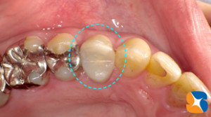 セレックで出来た被せ物を装着