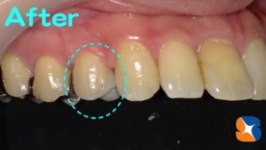 セレックでセラミック　綺麗な口元