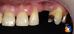 犬歯　欠損　入れ歯と分からない入れ歯