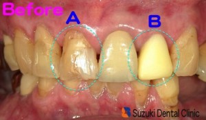 前歯の詰め物、被せ物の変色