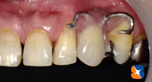 外れない　カタカタしない　入れ歯の金具を隠す入れ歯