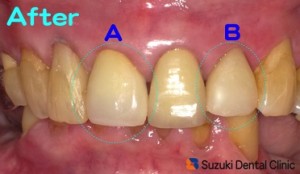 CAD/CAM セラミック