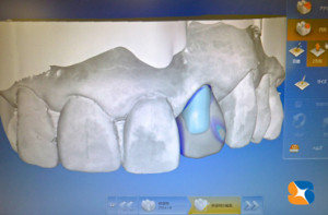 CADで100％セラミックを製作