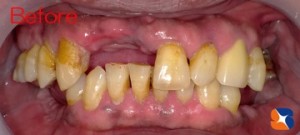 前歯に目立たない保険の入れ歯