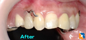 鈴木式デザイン入れ歯を装着