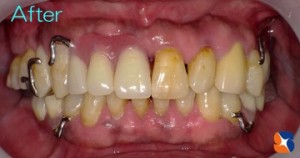 保険の入れ歯なのにデザインは自費の入れ歯