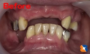 難しい噛み合わせ