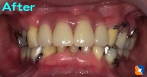 渾身の力で作った力作の入れ歯