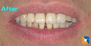 しっかり噛める見た目も良い入れ歯