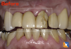 前歯　ブリッジ　保険で高品質