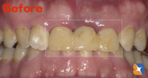 前歯　ブリッジ　保険　キレイ　奈良