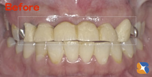 ６連結の前歯のブリッジ