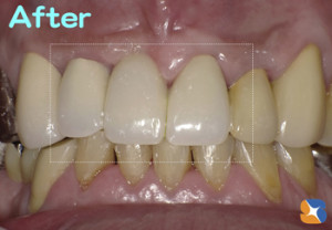 前歯　ブリッジ　保険で高品質
