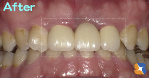 前歯　保険　ブリッジ　キレイ　奈良