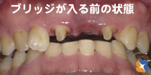 ３連結　ブリッジ　前歯　保険　奈良