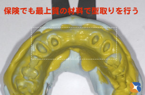 保険ではまず使用されることのない高額材料を無料奉仕