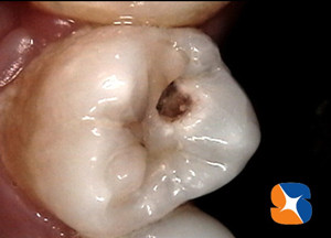 激しい痛みを伴う大きな虫歯