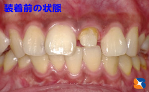 型取り前の状態