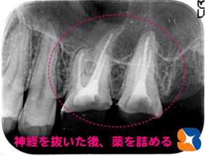 上の奥歯２本から神経を抜く