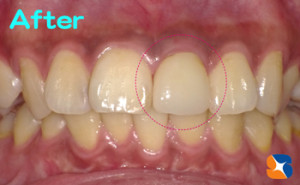 ドクター手製のオールセラミック