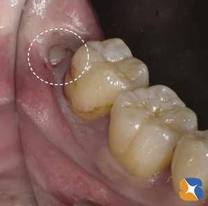 歯医者が抜きたくない親知らず