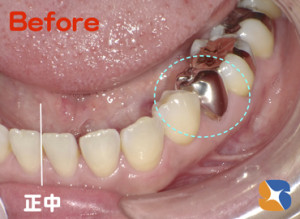 今までなら保険で銀色　今は白色