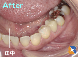 今までなら保険で銀色　今は白色