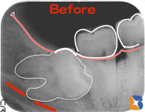 奥深い横向きの親知らず