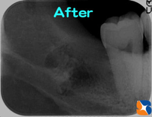 奥深い横向きの親知らず