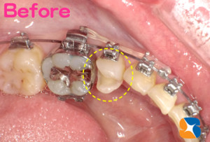 矯正中　詰め物とれた　きちんと詰め直す