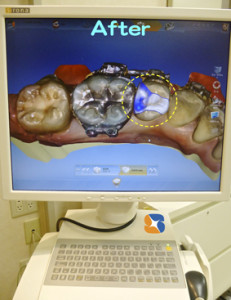 パソコン上でセラミックの詰め物を設計