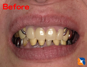 大きくて分厚い入れ歯