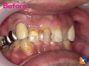 前歯がコンプレックス　キレイにしたい