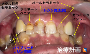 保険と自費治療で前歯を美しく改善