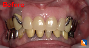 鼻の下まで延びた大きな入れ歯