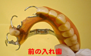 ごく一般的な保険の入れ歯