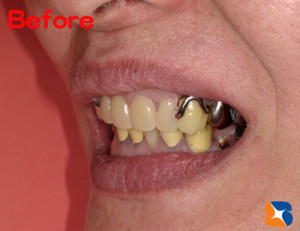 ギラギラ目立つ入れ歯のため、まともに笑えない