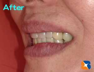 口元すっきり！笑える入れ歯で大満足！