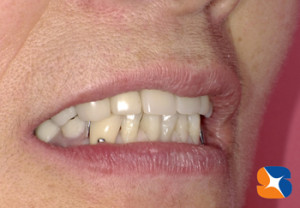 若返り、美しくなった口元