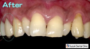 念願の奥歯の保険認可