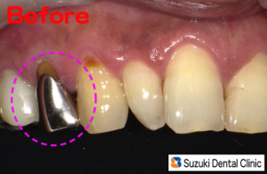 最新治療で奥歯は保険で白い歯